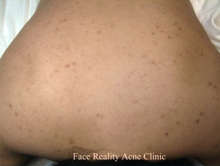 Back Acne Before