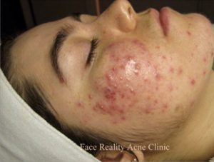 Inflamed Acne Before