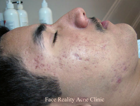 Inflamed Acne After