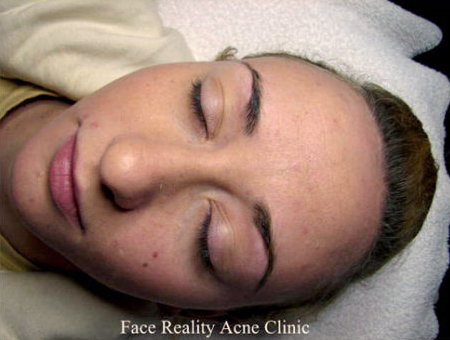 Noninflamed Acne After