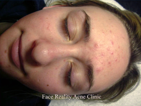 Noninflamed Acne Before