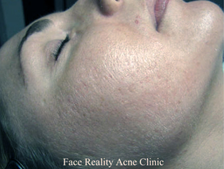 Noninflamed Acne After