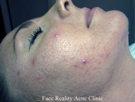 Noninflamed Acne Before